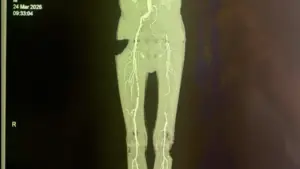 Loét gót chân kéo dài, bệnh nhân suýt phải cưa chân