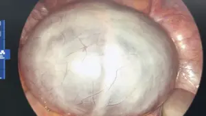 Phẫu thuật lấy khối u buồng trứng nặng khoảng 2kg ở người phụ nữ 33 tuổi