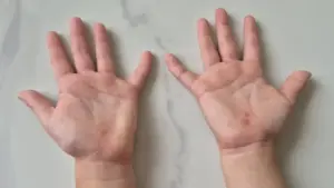 Sai lầm tước đi 'giờ vàng' cứu trẻ tay chân miệng