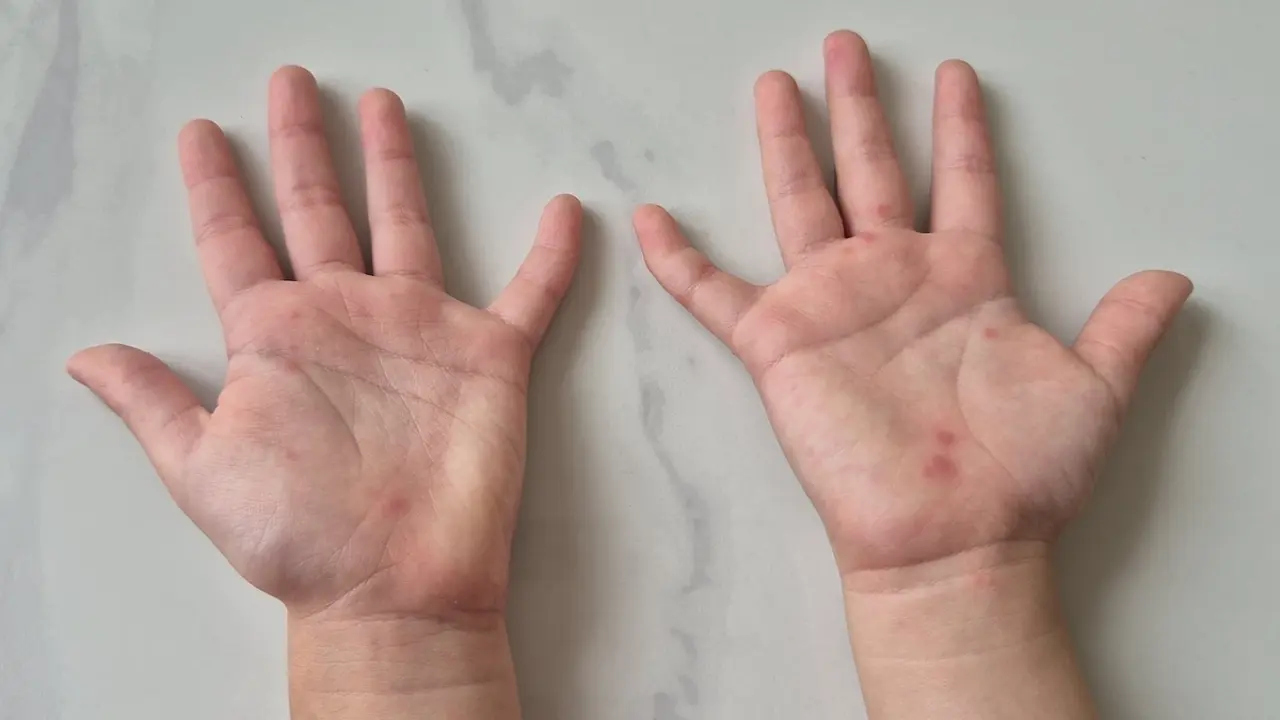 Sai lầm tước đi 'giờ vàng' cứu trẻ tay chân miệng