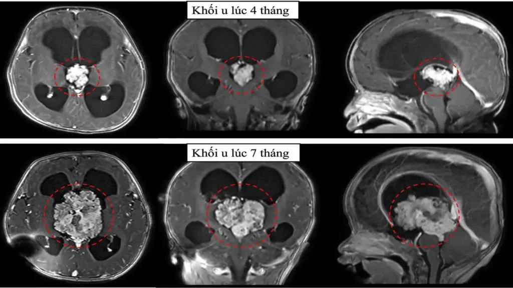 TPHCM: Cấp cứu cháu bé có khối u não to gấp ba lần chỉ trong 3 tháng