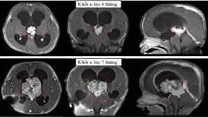 TPHCM: Cấp cứu cháu bé có khối u não to gấp ba lần chỉ trong 3 tháng