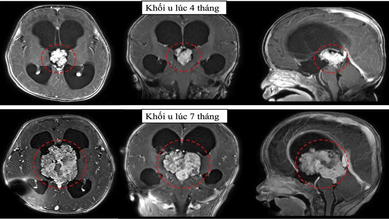TPHCM: Cấp cứu cháu bé có khối u não to gấp ba lần chỉ trong 3 tháng