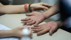 Vừa nắng nóng đầu mùa, bệnh da liễu đã bùng phát: Làm gì để phòng tránh?